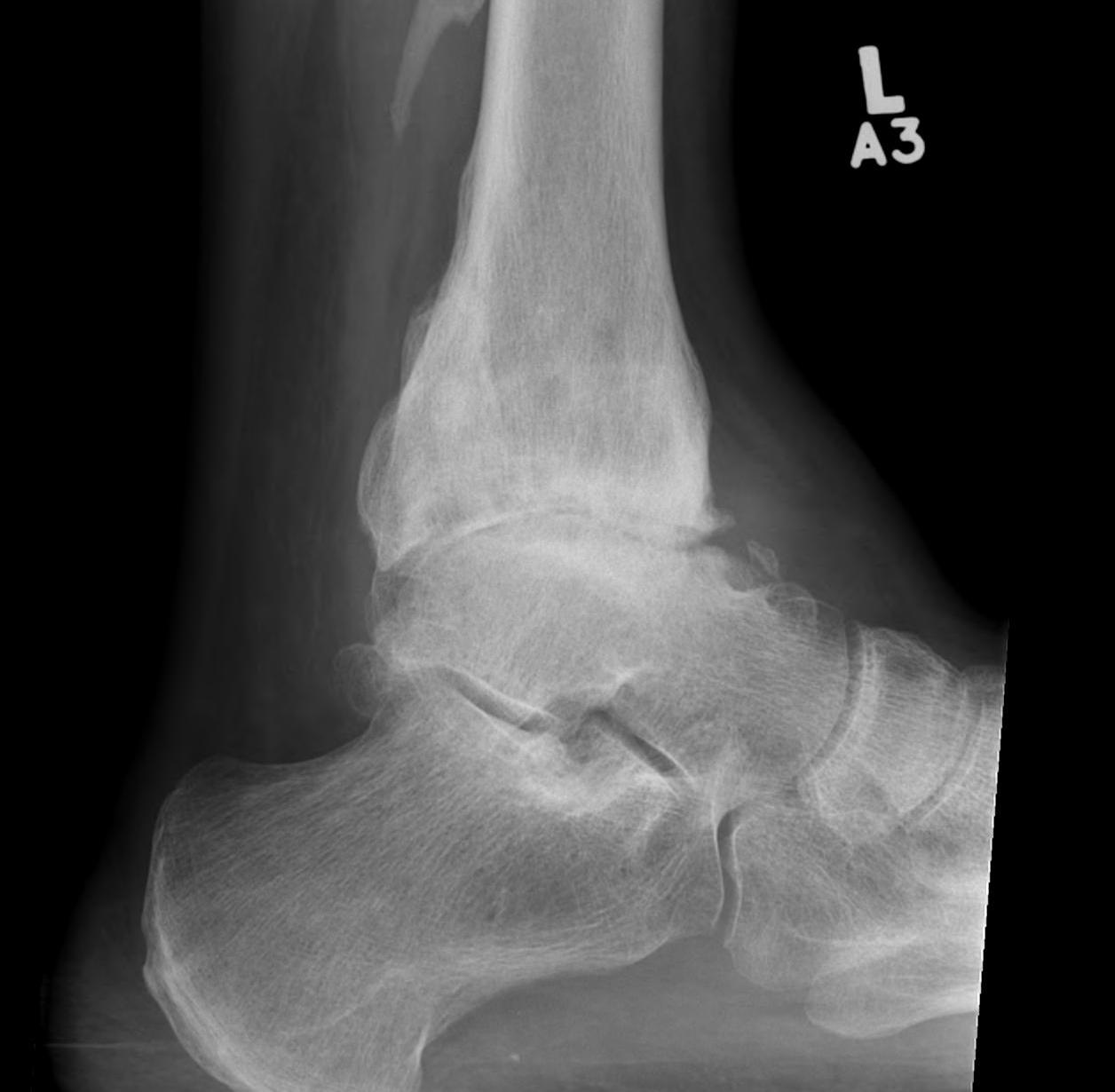 Ankle OA Lateral Xray